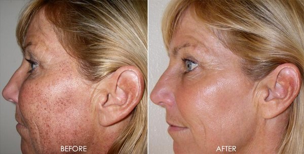 IPL photo facial - Lighten discoloration IPL photo facial - Lighten discoloration