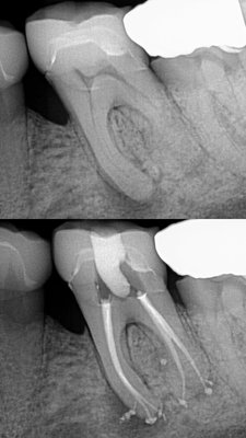Initial Root Canal - A beautifully done root canal utilizing state of the art equipment such as the Gentlewave cleansing unit. As well as the CBCT machine in order to accurately treat and save the tooth. Contact us to schedule your root canal appointment today! (949) 490-7772 Initial Root Canal - A beautifully done root canal utilizing state of the art equipment such as the Gentlewave cleansing unit. As well as the CBCT machine in order to accurately treat and save the tooth. Contact us to schedule your root canal appointment today! (949) 490-7772