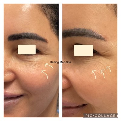 Rejuran - Salmon DNA - Rejuran is a skin rejuvenating treatment for increased collagen production and improvement of fine lines and skin texture giving a youthful glow after 1-3 sessions. Text (949)229-3789 for more info Rejuran - Salmon DNA - Rejuran is a skin rejuvenating treatment for increased collagen production and improvement of fine lines and skin texture giving a youthful glow after 1-3 sessions. Text (949)229-3789 for more info
