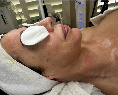 Customized corrective facial treatments - Skin Transformation in 8 sessions from our corrective facial treatments!
owaes
linicalstudio
You've gotta love a good before & after...
This beauty came with texture, fine lines, hyperpigmentation and dryness and skin laxity. After a series of corrective facial treatments (customized just for her skin), we're seeing major changes - clearer skin, smoother texture, and way more confidence!
Corrective facials treatments are about RESULTS.
If you're tired of trying products that don't work, it's that gets real, visible results.
Ready for your skin transformation?
Let's get you glowing from the inside out.
DM to book your consultation or click the link in bio!
#AcneSpecialist #CorrectiveFacials #BeforeAndAfter #SkincareThatWorks
#TemeculaEsthetician
#anti-aging specialists #melasma #rosacea #hydraglow #collageninductiontherapy #clinicalskincareforthewin #clinicalesthetician Customized corrective facial treatments - Skin Transformation in 8 sessions from our corrective facial treatments!
owaes
linicalstudio
You've gotta love a good before & after...
This beauty came with texture, fine lines, hyperpigmentation and dryness and skin laxity. After a series of corrective facial treatments (customized just for her skin), we're seeing major changes - clearer skin, smoother texture, and way more confidence!
Corrective facials treatments are about RESULTS.
If you're tired of trying products that don't work, it's that gets real, visible results.
Ready for your skin transformation?
Let's get you glowing from the inside out.
DM to book your consultation or click the link in bio!
#AcneSpecialist #CorrectiveFacials #BeforeAndAfter #SkincareThatWorks
#TemeculaEsthetician
#anti-aging specialists #melasma #rosacea #hydraglow #collageninductiontherapy #clinicalskincareforthewin #clinicalesthetician