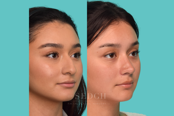 Female Rhinoplasty - This gallery showcases female rhinoplasty results by Dr. Jacob Sedgh, with a focus on natural refinement, facial harmony, and individualized surgical planning. Each rhinoplasty is tailored to the patient’s unique anatomy and aesthetic goals, addressing concerns such as dorsal humps, nasal asymmetry, tip shape, bridge contour, and overall proportion.

Dr. Sedgh’s approach is designed to enhance the nose while preserving the patient’s natural features and creating a balanced result that complements the entire face.