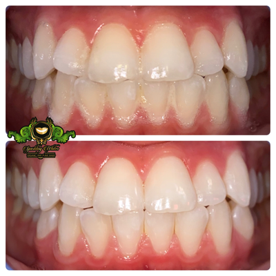 Check out these before and after photos! - Here at Sparkling Whites we use 100% Organic and Plant-Based ingredients! Book an appointment today!
