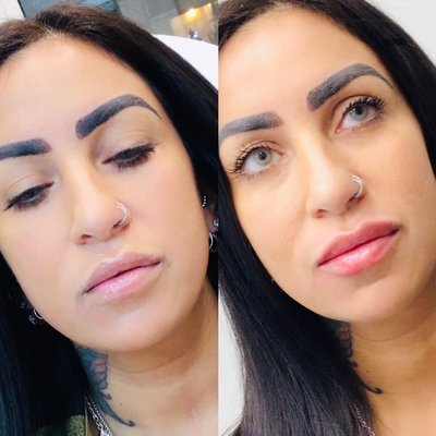 Before and Afters - Natural enhancement with lip filler Before and Afters - Natural enhancement with lip filler