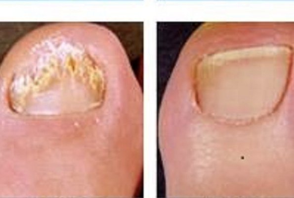 Laser Nail Therapy Improvement - Look at this fungal nail that we performed laser nail therapy on. The toenail is much improved after just 2 treatments !
