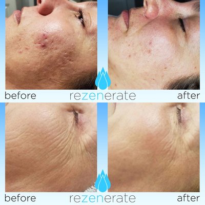 Rezenerate Nano Facial - Rezenerate Nano Facial (sometimes called a Nano-needling facial) improves skin texture and tone, tightens the skin, reduces sun spots and scars, and is fantastic at increasing collagen production.