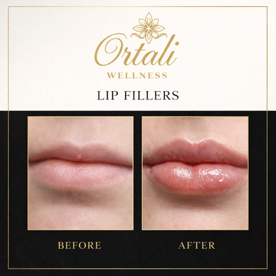 Dermal fillers - At Ortali Wellness, we believe that true beauty comes from subtle enhancement and balance. Dermal fillers provide a non-surgical, minimally invasive way to restore youthful volume, smooth fine lines, and refine facial contours—leaving you looking refreshed, rejuvenated, and naturally radiant. Whether your goal is fuller lips, lifted cheeks, a more defined jawline, or a softer appearance around your mouth, dermal fillers offer tailored solutions that highlight your unique features while maintaining natural beauty.