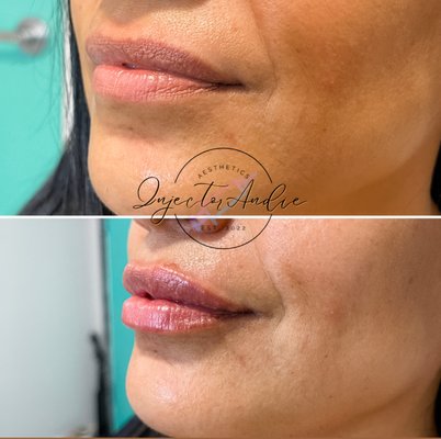 Lip Filler - February 2023 Valentines Special: purchase a full syringe of lip filler and get 50 units of Dysport free!