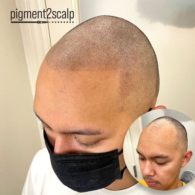 See the aesthetic hair tattoo progression over the 3 sessions.
Client: Norwood 4
Complementary Consultations Available - See the aesthetic hair tattoo progression over the 3 sessions. Scalp Micropigmentation with Pigment2scalp San Diego typically requires 3-4 sessions to complete the treatment.
Client: Norwood 4
Complementary Consultations Available See the aesthetic hair tattoo progression over the 3 sessions.
Client: Norwood 4
Complementary Consultations Available - See the aesthetic hair tattoo progression over the 3 sessions. Scalp Micropigmentation with Pigment2scalp San Diego typically requires 3-4 sessions to complete the treatment.
Client: Norwood 4
Complementary Consultations Available