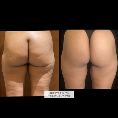 EmSculpt Neo
Increase 25% muscle and loose 30% fat - EmSculpt Neo before and After EmSculpt Neo
Increase 25% muscle and loose 30% fat - EmSculpt Neo before and After