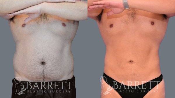 Liposuction Results 4 Months Post Op - Liposuction is an excellent procedure for patients in good overall health who maintain a healthy lifestyle but have one or more problem areas with stubborn fat. Patients should remember that liposuction cannot be used for substantial weight loss. Instead, it removes excess fat in localized regions after the patient has attempted other traditional weight loss methods.

Common treatment areas for liposuction include:
Thighs and Knees
Abdomen and Flanks
Arms
Back
Hips
Neck
Buttocks
Chest
Face and Neck
Calves
Ankles

Liposuction is often combined with other cosmetic procedures, such as a Brazilian Butt Lift (BBL), a fat transfer to the breasts, or a tummy tuck to achieve maximum results. During the initial consultation with Dr .Barrett, he will provide a comprehensive exam and discuss your goals to understand if this procedure is correct for you.