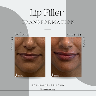 Lip Filler - Lip filler augmentation is a cosmetic procedure that modifies the shape of the lips using dermal fillers. The procedure may be performed to increase lip size, correct asymmetry, create protrusion, or adjust the ratio of the top and bottom lips. Lip Filler - Lip filler augmentation is a cosmetic procedure that modifies the shape of the lips using dermal fillers. The procedure may be performed to increase lip size, correct asymmetry, create protrusion, or adjust the ratio of the top and bottom lips.