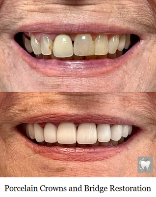 Porcelain Crowns and Bridge Restoration - This was a Porcelain Crowns and Bridge Restoration case that included a 3 unit bridge and nine porcelain crowns. Porcelain Crowns and Bridge Restoration - This was a Porcelain Crowns and Bridge Restoration case that included a 3 unit bridge and nine porcelain crowns.