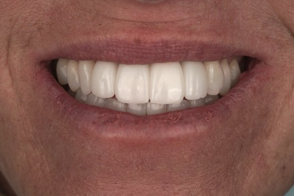 dental implants before and after - this patient had childhood trauma. was kicked in the face during a soccer game and after a series of root canals, infections, and more, she finally got dental implants. she never got any compliments on her teeth prior to this treatment. she finally got her confidence back and is so happy.