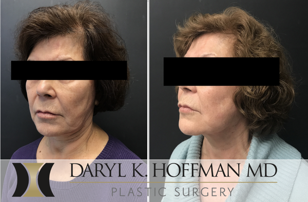 Facelift / Necklift - Over time, the contours of the face and appearance of the facial skin can begin to be affected by gravity, loss of elasticity, exposure to the elements, and everyday stresses of life. To reduce signs of facial aging, board-certified, Stanford-trained plastic surgeon Dr. Daryl K. Hoffman offers facelift surgery for San Jose and Palo Alto, CA, women and men.

Facelifts are designed to smooth the loose skin on the face and neck, minimizing wrinkles and giving the facial area a firmer, more youthful appearance. A facelift may be right for a man or a woman who has developed deep creases between their nose and mouth, excess skin on their cheeks, folds and fat deposits around their neck, or a jawline that has grown slack and jowly.