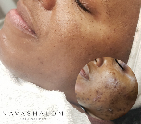 Acne Treatment Success - This beautiful soul first came in with skin in severe distress: a damaged barrier, congested pores, uncontrolled acne, and excessive hyperpigmentation. During her consultation, we discussed her personal lifestyle and nutrition habits and soon discovered specific habits that were negatively impacting her skin.
Once she was aware of the changes she needed to make, she was on board for her skin healing journey. She invested in her own home care to take care of her skin outside of the studio, and has maintained regular visits. Now, two years later, she has managed to maintain acne-free skin.
Studio treatments have included: extractions, chemical peels, high frequency, LED, microneedling.
Key ingredients have included: enzymes, alpha- and beta-hydroxy acids, antioxidants, Vitamin A, Vitamin C.
Lifestyle adjustments have included: no dairy, sugar, or processed foods; increased consumption of water and anti-inflammatory fruits and veggies; icing inflammatory breakouts. Acne Treatment Success - This beautiful soul first came in with skin in severe distress: a damaged barrier, congested pores, uncontrolled acne, and excessive hyperpigmentation. During her consultation, we discussed her personal lifestyle and nutrition habits and soon discovered specific habits that were negatively impacting her skin.
Once she was aware of the changes she needed to make, she was on board for her skin healing journey. She invested in her own home care to take care of her skin outside of the studio, and has maintained regular visits. Now, two years later, she has managed to maintain acne-free skin.
Studio treatments have included: extractions, chemical peels, high frequency, LED, microneedling.
Key ingredients have included: enzymes, alpha- and beta-hydroxy acids, antioxidants, Vitamin A, Vitamin C.
Lifestyle adjustments have included: no dairy, sugar, or processed foods; increased consumption of water and anti-inflammatory fruits and veggies; icing inflammatory breakouts.