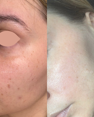 Virtual Client: Acne & Pigmentation Transformation, Breaking the Cycle - She had been dealing with breakouts since adolescence, and now, in her early 30s, the cycle still hadn’t stopped.
Every time her acne would calm down, she was left with pigmentation and uneven texture. Then the breakouts would return. Over and over again. A constant cycle of acne, dark spots, and frustration.
She had tried countless skincare products and facial treatments, always switching, always searching, but never seeing consistent, visible results.
Because she lives in another city, we began with a virtual consultation using detailed photos and an in-depth intake form. From there, I created a personalized routine tailored specifically to her skin type, acne patterns, pigmentation concerns, and sensitivity.
No random products.
No trendy products seen on social media.
No department store guessing.
Just a clear, strategic plan.
With a properly structured home routine, using targeted ingredients to address acne, post-inflammatory pigmentation, texture, and barrier health, her skin began to transform.
Breakouts became less frequent.
Pigmentation started to fade.
Texture improved.
Her skin looked calmer, brighter, and more even.
The most powerful part? These results were achieved without in-office treatments, just through consistency and a personalized routine at home.
Now she loves her products. She’s no longer jumping from brand to brand. She finally feels confident in her routine, and in her skin.
This is proof that when skincare is personalized, strategic, and designed specifically for your concerns, real results are possible, even virtually.
If you feel stuck in the acne-pigmentation cycle and don’t know what to use anymore, you don’t need more products. You need the right plan.
Ready for real change? Book your consultation with Rutina Skincare and begin your skin transformation. Virtual Client: Acne & Pigmentation Transformation, Breaking the Cycle - She had been dealing with breakouts since adolescence, and now, in her early 30s, the cycle still hadn’t stopped.
Every time her acne would calm down, she was left with pigmentation and uneven texture. Then the breakouts would return. Over and over again. A constant cycle of acne, dark spots, and frustration.
She had tried countless skincare products and facial treatments, always switching, always searching, but never seeing consistent, visible results.
Because she lives in another city, we began with a virtual consultation using detailed photos and an in-depth intake form. From there, I created a personalized routine tailored specifically to her skin type, acne patterns, pigmentation concerns, and sensitivity.
No random products.
No trendy products seen on social media.
No department store guessing.
Just a clear, strategic plan.
With a properly structured home routine, using targeted ingredients to address acne, post-inflammatory pigmentation, texture, and barrier health, her skin began to transform.
Breakouts became less frequent.
Pigmentation started to fade.
Texture improved.
Her skin looked calmer, brighter, and more even.
The most powerful part? These results were achieved without in-office treatments, just through consistency and a personalized routine at home.
Now she loves her products. She’s no longer jumping from brand to brand. She finally feels confident in her routine, and in her skin.
This is proof that when skincare is personalized, strategic, and designed specifically for your concerns, real results are possible, even virtually.
If you feel stuck in the acne-pigmentation cycle and don’t know what to use anymore, you don’t need more products. You need the right plan.
Ready for real change? Book your consultation with Rutina Skincare and begin your skin transformation.