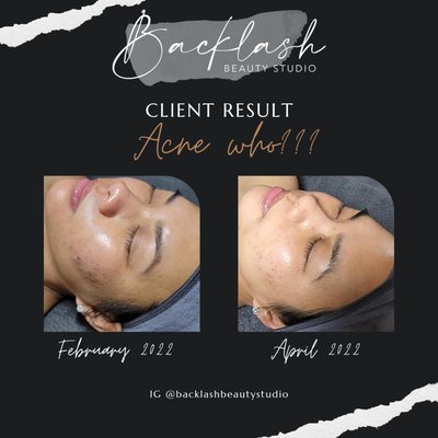 Facial Treatments - Acne Facial Treatments showing quick results with a proper skin care regimen and progressive facials consistently once a month.