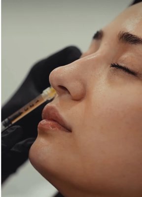 Undereye + PRF - PRF injections are a beneficial treatment for under-eye dark circles because they promote natural healing and rejuvenation. Platelet-rich fibrin (PRF) is derived from your own blood, making it a safe and natural option. When injected into the under-eye area, PRF releases growth factors that stimulate collagen production and improve blood circulation. This helps to thicken the skin and reduce the appearance of dark circles. PRF injections also enhance skin elasticity, reducing fine lines and wrinkles. The treatment is minimally invasive and requires minimal downtime, making it a convenient and effective solution for achieving brighter, more rejuvenated under-eye skin. Undereye + PRF - PRF injections are a beneficial treatment for under-eye dark circles because they promote natural healing and rejuvenation. Platelet-rich fibrin (PRF) is derived from your own blood, making it a safe and natural option. When injected into the under-eye area, PRF releases growth factors that stimulate collagen production and improve blood circulation. This helps to thicken the skin and reduce the appearance of dark circles. PRF injections also enhance skin elasticity, reducing fine lines and wrinkles. The treatment is minimally invasive and requires minimal downtime, making it a convenient and effective solution for achieving brighter, more rejuvenated under-eye skin.