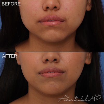 Buccal Fat Reduction - Buccal fat reduction is a surgery that reduces the fat pad in the lower cheeks. Reducing this fat can highlight the bone structure in your face between your cheeks and jawline.