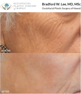 Laser Procedures - Dr. Bradford Lee offers laser skin resurfacing, sunspot removal, scar removal, and tattoo removal services. Patients can find that laser treatments not only reduce wrinkles and fine lines but can also help improve the texture, tone, and dark spots on the skin. Laser Procedures - Dr. Bradford Lee offers laser skin resurfacing, sunspot removal, scar removal, and tattoo removal services. Patients can find that laser treatments not only reduce wrinkles and fine lines but can also help improve the texture, tone, and dark spots on the skin.