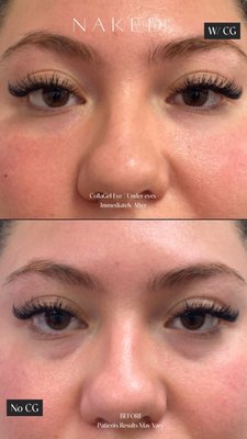 CollaGel - CollaGel Procedure CollaGel - CollaGel Procedure