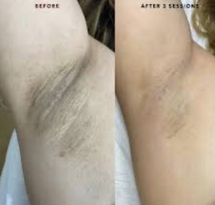 Skin Lightening Treatment - We have many different skin lightning treatments to suit your needs. It is best to book a skin consultation in order to assess which treatment your skin needs Skin Lightening Treatment - We have many different skin lightning treatments to suit your needs. It is best to book a skin consultation in order to assess which treatment your skin needs