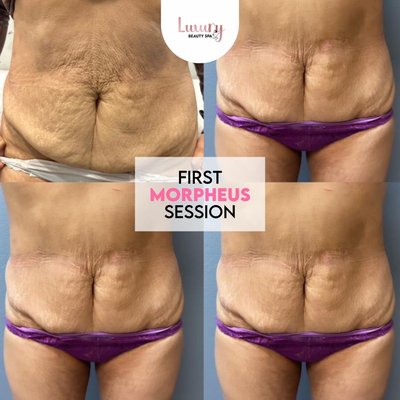 body contouring - We have a financing plan up to six months with zero interest we work with Afterpay affirm