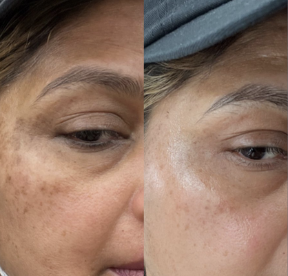 Age Spot Treatment - This client had been struggling with age spots for many years and had tried several treatments before. Upon a friend’s recommendation, he came to us. With our exclusive professional laser treatment combined with the “topical sculpture Treatment”, after just three sessions, the results have been remarkable — not only have the spots significantly lightened, but his skin has also become noticeably firmer and more radiant, making him very happy with the outcome Age Spot Treatment - This client had been struggling with age spots for many years and had tried several treatments before. Upon a friend’s recommendation, he came to us. With our exclusive professional laser treatment combined with the “topical sculpture Treatment”, after just three sessions, the results have been remarkable — not only have the spots significantly lightened, but his skin has also become noticeably firmer and more radiant, making him very happy with the outcome