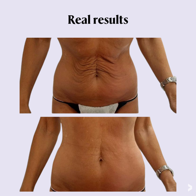 T-Shape 2 - Face + Body - T-Shape 2 is a powerful, FDA-cleared Class II device designed for both facial and body contouring. This multifunctional platform combines advanced technologies to rejuvenate skin, sculpt the body, and boost circulation—all without surgery or downtime. It delivers remarkable aesthetic results without needles, scalpels, bruising, or recovery. While gentle on the surface, T-Shape 2 works deep within your body’s natural systems, energizing, refining, and renewing from the inside out. Science-backed beauty that’s transformative, powerful, and refreshingly non-invasive. T-Shape 2 - Face + Body - T-Shape 2 is a powerful, FDA-cleared Class II device designed for both facial and body contouring. This multifunctional platform combines advanced technologies to rejuvenate skin, sculpt the body, and boost circulation—all without surgery or downtime. It delivers remarkable aesthetic results without needles, scalpels, bruising, or recovery. While gentle on the surface, T-Shape 2 works deep within your body’s natural systems, energizing, refining, and renewing from the inside out. Science-backed beauty that’s transformative, powerful, and refreshingly non-invasive.