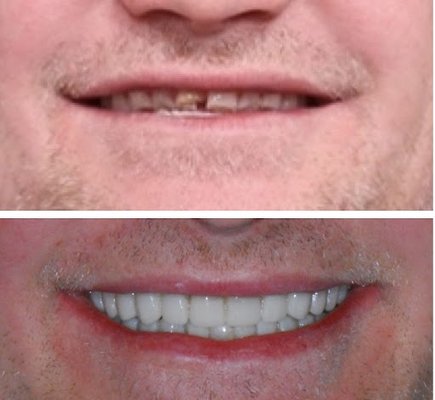 Full mouth rehabilitation - Thinking he need all teeth removed, an alternative option allowed him to save all his teeth and get the smile he dreamed of.