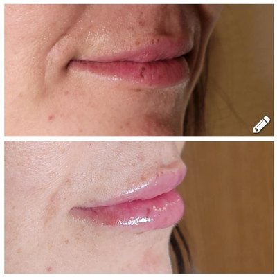 Lip filler before and after - This is a before and after of lip filler using 1 syringe of Restylane Kysse.