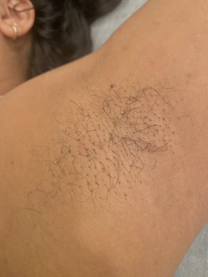 Underarm Sugar - 4 weeks maintenance. The hair grows back slowly and no more irritation from shaving!