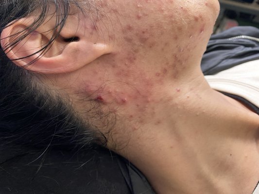 Acne Treatment - We are still working together to get her acne under control with weekly treatments. The acne is drying out and she is on her way to healthy skin. Acne Treatment - We are still working together to get her acne under control with weekly treatments. The acne is drying out and she is on her way to healthy skin.