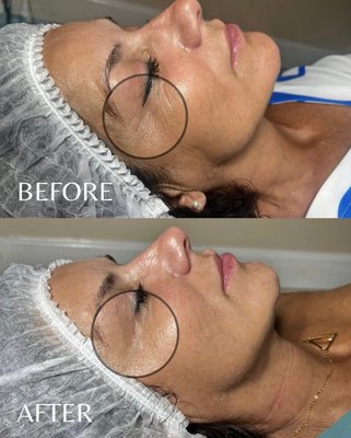 Microneelding With Plasma - Rejuvenating treatment that combines tiny skin-boosting micro-injuries with your body’s own platelet-rich plasma to stimulate collagen, speed up healing, and improve overall skin tone and texture. Benefits include smoother, firmer skin, reduced fine lines and wrinkles, acne scars, and a healthy, radiant glow. Microneelding With Plasma - Rejuvenating treatment that combines tiny skin-boosting micro-injuries with your body’s own platelet-rich plasma to stimulate collagen, speed up healing, and improve overall skin tone and texture. Benefits include smoother, firmer skin, reduced fine lines and wrinkles, acne scars, and a healthy, radiant glow.
