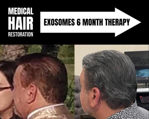 Medical Hair Restoration - Alpha Advantage specializes in the most advanced non-surgical hair restoration therapies including amnion, exosomes and stem cells proven to stimulate your own hair to grow back thick and its original color.   

Why we are the best.

Alpha Advantage has developed a proprietary scalp/hair optimization protocol that first creates the ideal conditions for microvessel blood flow to nourish the cells in the hair bulb; then introduces powerful placenta-derived growth factor and medication to regenerate hair growth, thickness and original color.

We beat the competition on every level and encourage you to compare.  

We offer:  

1) BEST DIAGNOSTICS
We have the most comprehensive hair and scalp testing procedures in the industry to accurately identify which type of hair loss you have.  And unlike the competition; we test every 30 days to monitor your treatment to ensure success and safety.  Testing includes high resolution hair pattern imaging; a microscopic analysis of the hair follicles, bulbs and scalp; and blood chemistry to baseline and monitor overall blood health and DHT levels.

2) BEST THERAPIES
We use the most advanced hair restoration therapies available. All proven to increase micro blood flow to scalp and stimulate hair growth.  
* Regenerative Tissue Procedures - use of stem cells, exosomes and amnion products that have the most powerful growth factor or healing properties known to medical science.
* Dermal-Infused Medication - used with a hydraneedle or mircroneedle dermaroller to maximize dermal absorption (up to 1,500X) and maximize therapeutic effect.
* Intense Red-Light Therapy - red-light helmet worn to improve cellular energy and optimize hair growth conditions. 
* Manual Scalp Therapy -  rough scalp massage with a debridement brush removes dead tissue, opens up pores and manually manipulates the scalp tissue to encourage micro blow flow.

3) GUARANTEED RESULTS
Our medical procedures work very well to restore hair growth.  We stand by our work and guarantee real improvement and provable hair growth results or your money back.  Give us a chance and we’ll grow your hair back.

4) BEST PRICING
30% to 60% less than our competitor.