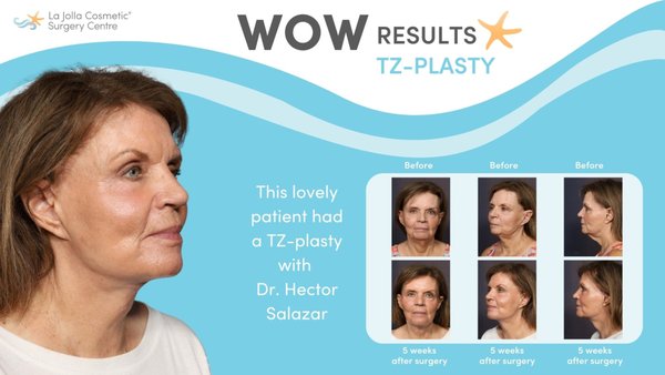 TZ-plasty - Here are before and after photos of TZ-plasty results by the board-certified plastic surgeons at La Jolla Cosmetic Surgery Centre in La Jolla, CA. TZ-plasty - Here are before and after photos of TZ-plasty results by the board-certified plastic surgeons at La Jolla Cosmetic Surgery Centre in La Jolla, CA.