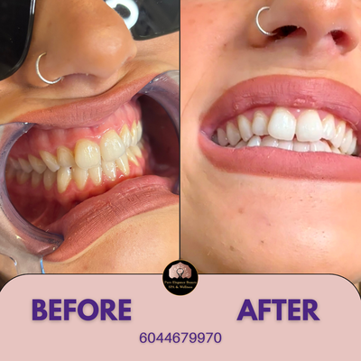 Teeth Whitening - Brighten your smile with our professional Teeth Whitening service, delivering a dazzling and confident smile effortlessly. Experience noticeable results in just one session! Teeth Whitening - Brighten your smile with our professional Teeth Whitening service, delivering a dazzling and confident smile effortlessly. Experience noticeable results in just one session!