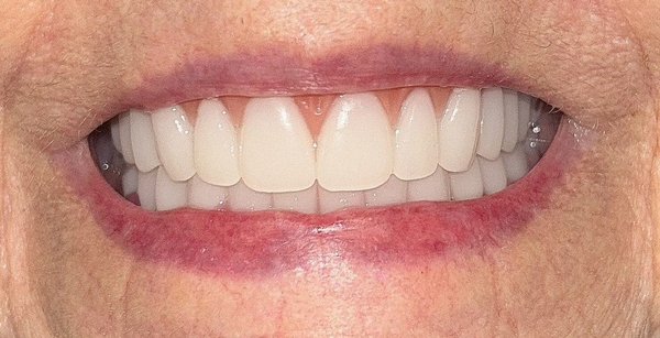 Dentures - Dental dentures are removable appliances that can replace missing teeth and help restore your smile.
