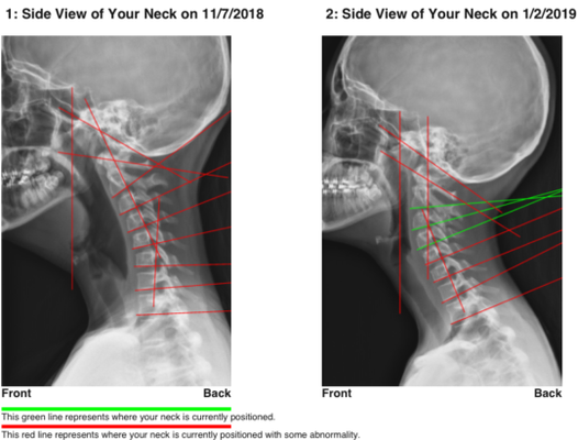 Scoliosis and Cervical Curve Correction - Correction of Cervical Curve and Forward Head Translation which helped to resolve severe migraines.
Reduction of Adolescent Scoliosis from Moderate to Mild Scoliosis in 4 months. Scoliosis and Cervical Curve Correction - Correction of Cervical Curve and Forward Head Translation which helped to resolve severe migraines.
Reduction of Adolescent Scoliosis from Moderate to Mild Scoliosis in 4 months.