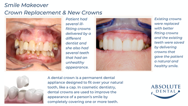 Crown Replacement - Patient had several ill-fitting crowns delivered by a different dentist and she also had several teeth that had an unhealthy appearance.
Existing crowns were replaced with better fitting crowns and the existing teeth were saved by delivering crowns that gave the patient a natural and healthy smile. Crown Replacement - Patient had several ill-fitting crowns delivered by a different dentist and she also had several teeth that had an unhealthy appearance.
Existing crowns were replaced with better fitting crowns and the existing teeth were saved by delivering crowns that gave the patient a natural and healthy smile.