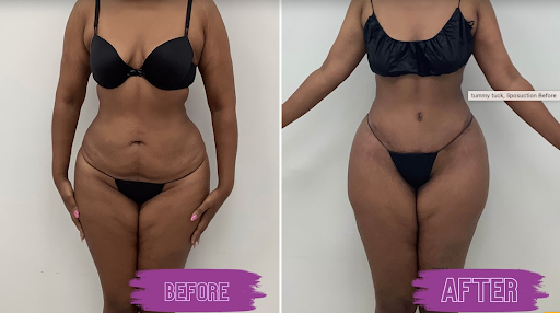 Tummy Tuck - Sagging skin and excess fat along the abdomen can be frustrating and challenging despite attempts to get rid of it. Significant weight loss, childbirth, and aging are the primary reasons why an individual may not be able to regain a tighter and slimmer stomach. An abdominoplasty is a body contouring procedure that reshapes the stomach area, producing great outcomes for patients. Board-certified surgeon Dr. Tsion Berhane performs tummy tuck surgery based on each individual's cosmetic goals. This popular surgery at Jubilee Cosmetic Surgery allows you to gain a gorgeous new figure and restored confidence. With a tummy tuck, you can eliminate excess skin and fat while also tightening the abdominal muscles. To learn more about the tummy tuck procedure, we invite you to contact our Silver Spring, MD office for your consultation. Tummy Tuck - Sagging skin and excess fat along the abdomen can be frustrating and challenging despite attempts to get rid of it. Significant weight loss, childbirth, and aging are the primary reasons why an individual may not be able to regain a tighter and slimmer stomach. An abdominoplasty is a body contouring procedure that reshapes the stomach area, producing great outcomes for patients. Board-certified surgeon Dr. Tsion Berhane performs tummy tuck surgery based on each individual's cosmetic goals. This popular surgery at Jubilee Cosmetic Surgery allows you to gain a gorgeous new figure and restored confidence. With a tummy tuck, you can eliminate excess skin and fat while also tightening the abdominal muscles. To learn more about the tummy tuck procedure, we invite you to contact our Silver Spring, MD office for your consultation.