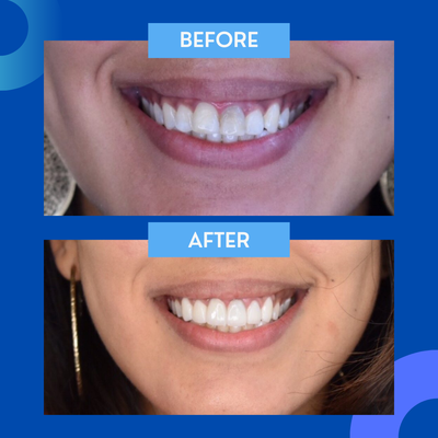 Veneers - Veneers before and after Veneers - Veneers before and after