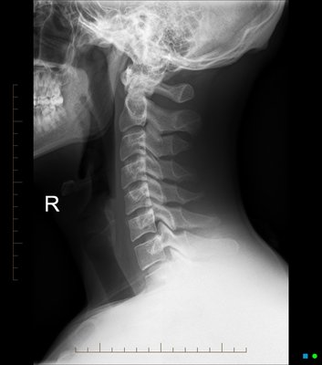 Auto Accident Chiropractic - We treat patients after an auto accident with zero cost to you with an attorney. We have helped thousands of people post accident. Contact us today 9496003435 for a consultation with the doctor.
We work with other personal injury attorneys on a lien basis! Auto Accident Chiropractic - We treat patients after an auto accident with zero cost to you with an attorney. We have helped thousands of people post accident. Contact us today 9496003435 for a consultation with the doctor.
We work with other personal injury attorneys on a lien basis!