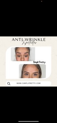 Ageless beauty for less - With just 30 units of Botox you too can minimize the appearance of deep wrinkles or prevent wrinkles and lines from forming in the first place.
Botox results last about 3-4 months, after which you can return for another treatment to keep lines and wrinkles at bay. With our affordable price! Excellent service! Don’t pay more. Ageless beauty for less - With just 30 units of Botox you too can minimize the appearance of deep wrinkles or prevent wrinkles and lines from forming in the first place.
Botox results last about 3-4 months, after which you can return for another treatment to keep lines and wrinkles at bay. With our affordable price! Excellent service! Don’t pay more.