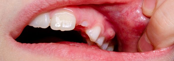 Why Does Tooth Pain Hurt So Much? - Teeth have three layers: enamel (outer), dentin (middle), and the pulp (nerve). When decay or damage reaches the nerve, the pain becomes sharp, throbbing, and hard to ignore. That’s why toothaches feel like emergencies they mean the problem has gone deep and needs immediate care. Ignoring dental pain can lead to worse issues, so don’t wait to see your dentist.