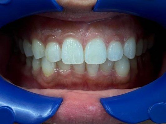 New Smile with Invisalign! - Brought this New Smile to Life with Invisalign! New Smile with Invisalign! - Brought this New Smile to Life with Invisalign!