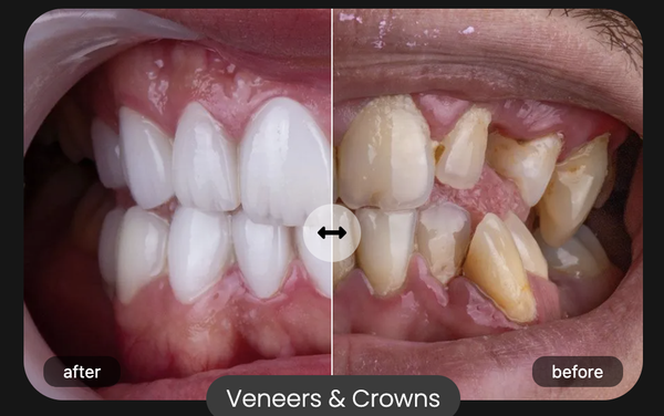Comprehensive, Advanced Cosmetic and Restorative Dentistry - Discover your dream smile today
Ask about our wellness menu with:
- Beauty face masks
- Gel eye masks
- Hot and cold towel therapy
- Beverage station
- Noise cancelling headphones
- Quiet equipment
- Aromatherapy
- Light sedation options including sleep dentistry
- Personal TVs
- Blankets Comprehensive, Advanced Cosmetic and Restorative Dentistry - Discover your dream smile today
Ask about our wellness menu with:
- Beauty face masks
- Gel eye masks
- Hot and cold towel therapy
- Beverage station
- Noise cancelling headphones
- Quiet equipment
- Aromatherapy
- Light sedation options including sleep dentistry
- Personal TVs
- Blankets
