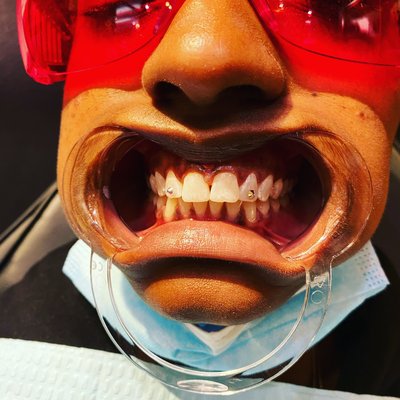 Teeth Gem Implants - Multiple styles of Tooth Gem Implants Teeth Gem Implants - Multiple styles of Tooth Gem Implants