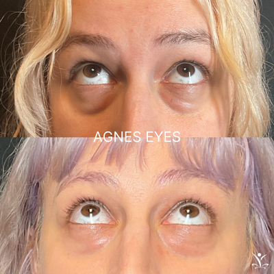 RF Microneedling Before & After's - RF Microneedling before and after photos. RF Microneedling Before & After's - RF Microneedling before and after photos.