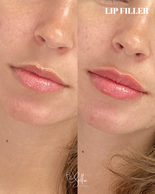 Lips of every shape and size! - This is what lips in Miami are supposed to look like.
Soft. Natural. Undetectable. Never overdone or unnatural.
Selfie Aesthetic - Miami's most trusted aesthetic practice for the past 5 years. Lips of every shape and size! - This is what lips in Miami are supposed to look like.
Soft. Natural. Undetectable. Never overdone or unnatural.
Selfie Aesthetic - Miami's most trusted aesthetic practice for the past 5 years.